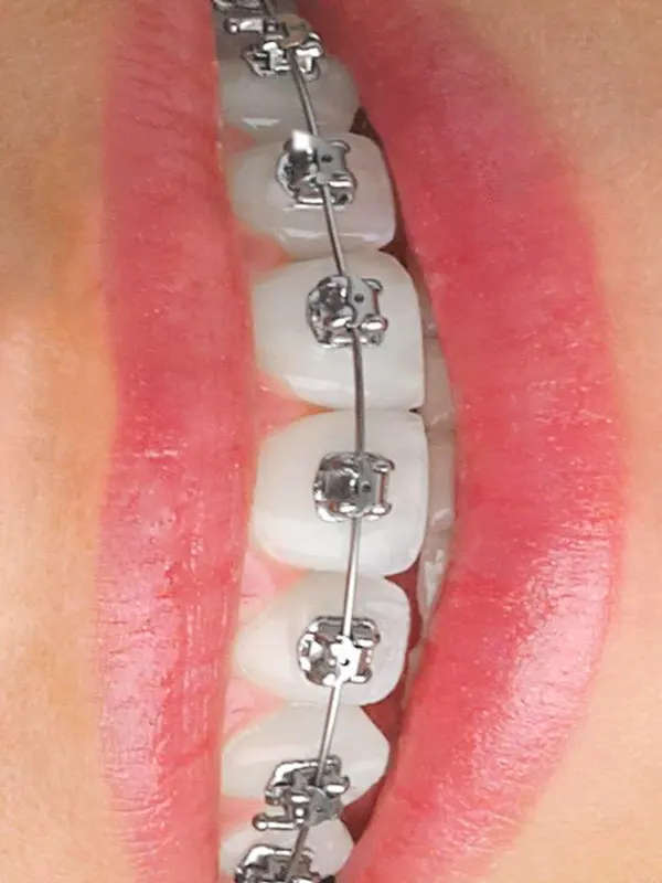 img-orthodontics-treatment-bogota-colombia-1