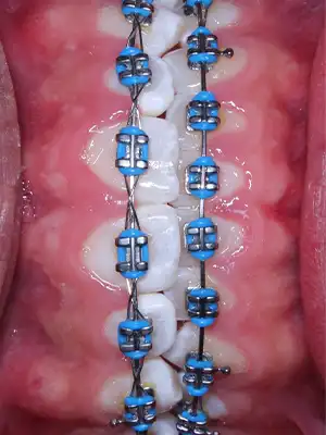 img-ortodoncia-convecional-en-bogota-2-LCP